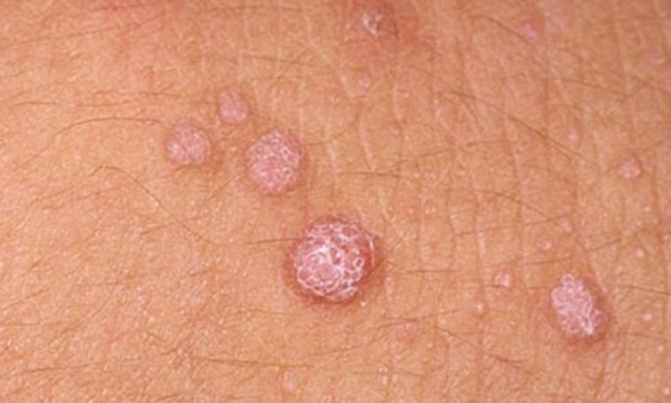 HPV води до появата на папиломи по кожата