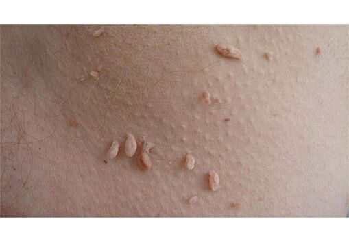 Признак на HPV инфекция е появата на папиломи по тялото