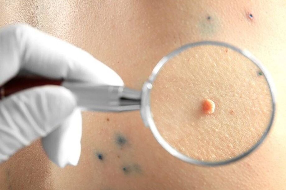 HPV лечение