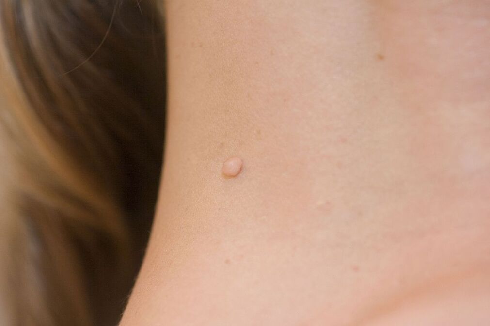 HPV симптоми